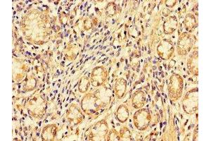 Immunohistochemistry of paraffin-embedded human gastric cancer using ABIN7151097 at dilution of 1:100 (PDZRN3 抗体  (AA 133-404))