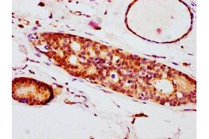IHC image of ABIN7127691 diluted at 1:100 and staining in paraffin-embedded human breast cancer performed on a Leica BondTM system. (Recombinant EIF4E 抗体  (pSer209))