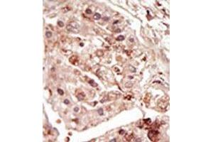 Formalin-fixed and paraffin-embedded human cancer tissue (hepatocarcinoma) reacted with the primary antibody, which was peroxidase-conjugated to the secondary antibody, followed by DAB staining. (STK31 抗体  (C-Term))