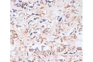 Immunohistochemistry of paraffin-embedded Human breast cancer using EIF4EBP1 Polyclonal Antibody at dilution of 1:100 (40x lens). (eIF4EBP1 抗体)