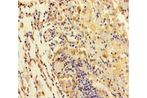 Immunohistochemistry of paraffin-embedded human lung cancer using ABIN7171552 at dilution of 1:100 (TAS2R42 抗体  (AA 149-187))
