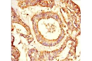 Immunohistochemistry of paraffin-embedded human endometrial cancer using ABIN7161918 at dilution of 1:100 (NRBP2 抗体  (AA 12-258))