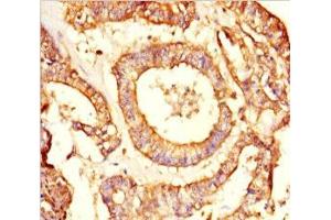 Immunohistochemistry of paraffin-embedded human endometrial cancer using ABIN7161918 at dilution of 1:100
