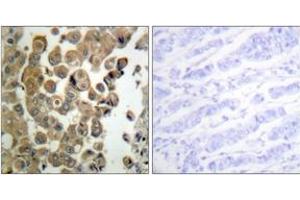 Immunohistochemistry analysis of paraffin-embedded human breast carcinoma, using PKC delta (Phospho-Thr505) Antibody. (PKC delta 抗体  (pThr507))