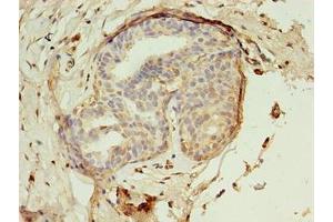 Immunohistochemistry of paraffin-embedded human breast cancer using ABIN7142288 at dilution of 1:100 (EBP 抗体  (AA 2-230))