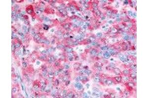 Human Ovarian Carcinoma (formalin-fixed, paraffin-embedded) stained with EGFR antibody ABIN213614 at 2. (EGFR 抗体)