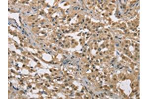 The image on the left is immunohistochemistry of paraffin-embedded Human thyroid cancer tissue using ABIN7129149(DACH2 Antibody) at dilution 1/40, on the right is treated with fusion protein. (DACH2 抗体)