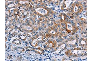 The image on the left is immunohistochemistry of paraffin-embedded Human thyroid cancer tissue using ABIN7128771(CASC3 Antibody) at dilution 1/20, on the right is treated with fusion protein. (CASC3 抗体)