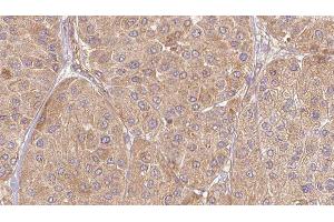 ABIN6277133 at 1/100 staining Human Melanoma tissue by IHC-P. (ELSPBP1 抗体  (C-Term))