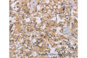Immunohistochemistry of Human thyroid cancer using ACTN4 Polyclonal Antibody at dilution of 1:60