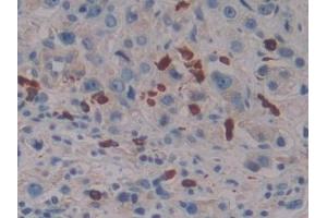 Detection of LAT2 in Human Prostate cancer Tissue using Polyclonal Antibody to Linker For Activation Of T-Cells Family, Member 2 (LAT2) (LAT2 抗体  (AA 30-209))