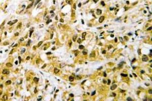 Immunohistochemistry (IHC) analyzes of NF-YC antibody in paraffin-embedded human liver carcinoma tissue. (NFYC 抗体)