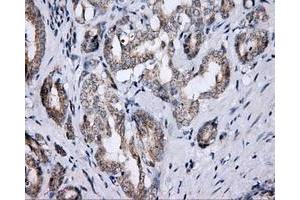 Immunohistochemical staining of paraffin-embedded Carcinoma of thyroid tissue using anti-LIPG mouse monoclonal antibody. (LIPG 抗体)