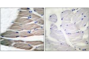 Immunohistochemistry analysis of paraffin-embedded human breast carcinoma, using ACC1 (Phospho-Ser80) Antibody. (Acetyl-CoA Carboxylase alpha 抗体  (pSer80))