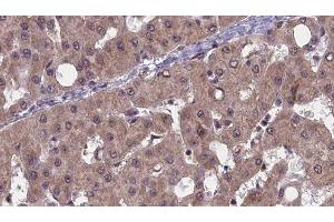 ABIN6277491 at 1/100 staining Human liver cancer tissue by IHC-P. (PAK1 抗体  (Internal Region))