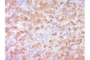 Paraformaldehyde-fixed, paraffin embedded human liver cancer, Antigen retrieval by boiling in sodium citrate buffer (pH6) for 15min, Block endogenous peroxidase by 3% hydrogen peroxide for 30 minutes, Blocking buffer (normal goat serum) at 37°C for 20min, Antibody incubation with Rabbit Anti-Cytochrome b245 Light Chain Polyclonal Antibody, Unconjugated  at 1:500 overnight at 4°C, followed by a conjugated secondary and DAB staining. (CYBA 抗体  (AA 21-120))