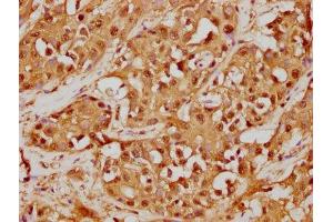 IHC image of ABIN7127533 diluted at 1:125 and staining in paraffin-embedded human liver cancer performed on a Leica BondTM system. (Recombinant GSTO1 抗体)