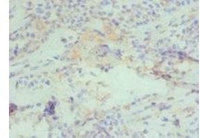 Immunohistochemistry of paraffin-embedded human breast cancer using ABIN7150954 at dilution of 1:100 (CBX4 抗体  (AA 401-560))