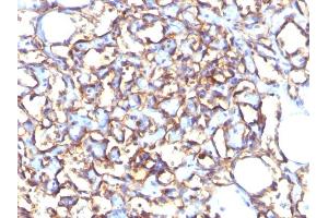 Formalin-fixed, paraffin-embedded human Angiosarcoma stained with Podocalyxin Mouse Monoclonal Antibody (3D3). (PODXL 抗体  (Extracellular Domain))