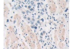 Detection of PKD2 in Human Stomach cancer Tissue using Polyclonal Antibody to Protein Kinase D2 (PKD2) (PKD2 抗体  (AA 621-832))