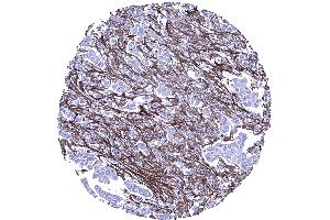 Abundant periostin positive stroma in an invasive lobular breast cancer (Periostin 抗体  (AA 193-326))