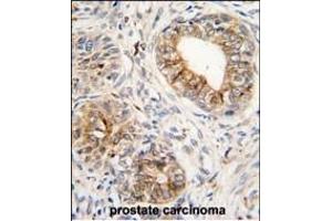 Formalin-fixed and paraffin-embedded human prostata carcinoma tissue reacted with PTGS1 antibody (C-term) (ABIN1882120 and ABIN2839444) , which was peroxidase-conjugated to the secondary antibody, followed by DAB staining. (PTGS1 抗体  (C-Term))