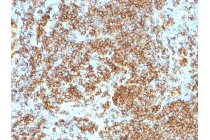 Formalin-fixed, paraffin-embedded human Lymphoma stained with CD45RB Monoclonal Antibody (PTPRC/1132). (CD45 抗体)