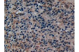 Detection of DISC1 in Human Prostate cancer Tissue using Polyclonal Antibody to Disrupted In Schizophrenia 1 (DISC1) (DISC1 抗体  (AA 102-261))