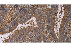 Immunohistochemistry of paraffin-embedded Human colon cancer using FADS1 Polyclonal Antibody at dilution of 1:60 (FADS1 抗体)