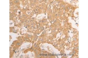 Immunohistochemistry of Human lung cancer using NAP1L1 Polyclonal Antibody at dilution of 1:50 (NAP1L1 抗体)
