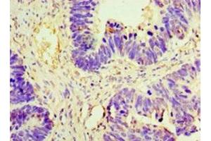 Immunohistochemistry of paraffin-embedded human ovarian cancer using ABIN7160302 at dilution of 1:100