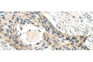 Immunohistochemistry of paraffin-embedded Human esophagus cancer tissue using CCL13 Polyclonal Antibody at dilution 1:40 (CCL13 抗体)