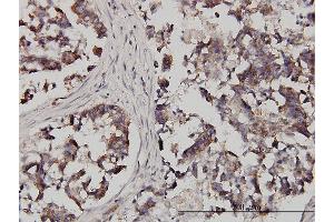 Immunoperoxidase of monoclonal antibody to FXR1 on formalin-fixed paraffin-embedded human colon adenocarcinoma. (FXR1 抗体  (AA 121-220))