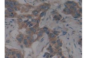 Detection of SCFR in Human Breast cancer Tissue using Polyclonal Antibody to Stem Cell Factor Receptor (SCFR) (KIT 抗体  (AA 321-520))