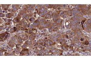 ABIN6273837 at 1/100 staining Human liver cancer tissue by IHC-P. (Serotonin Receptor 3A 抗体  (Internal Region))
