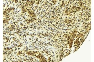 ABIN6278092 at 1/100 staining Human breast cancer tissue by IHC-P.