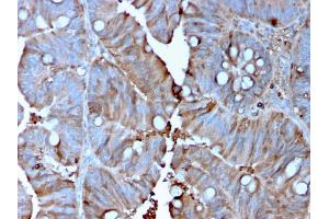 Formalin-fixed, paraffin-embedded human Colon Carcinoma stained with MerTK Mouse Monoclonal Antibody (MERTK/3015). (MERTK 抗体  (AA 55-148))