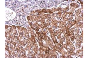 IHC-P Image PLGF antibody detects PGF protein at cytosol on human hepatoma by immunohistochemical analysis. (PLGF 抗体)