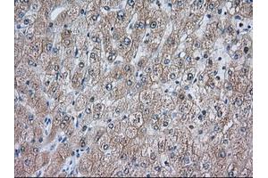 Immunohistochemical staining of paraffin-embedded Carcinoma of Human prostate tissue using anti-ACAT2 mouse monoclonal antibody. (ACAT2 抗体)