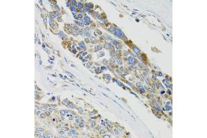 Immunohistochemistry of paraffin-embedded human liver cancer using SH2B1 Antibody (ABIN5973245) at dilution of 1/100 (40x lens). (SH2B1 抗体)