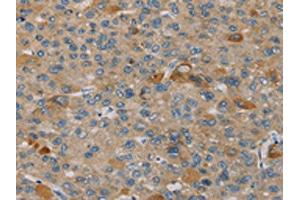 The image on the left is immunohistochemistry of paraffin-embedded Human liver cancer tissue using ABIN7130584(PEF1 Antibody) at dilution 1/20, on the right is treated with fusion protein. (PEF1 抗体)