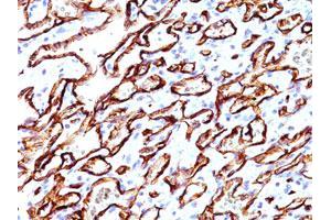 Immunohistochemical staining of human angiosarcoma (20X) with PODXL monoclonal antibody, clone 3D3  at 1:500 dilution. (PODXL 抗体  (Extracellular Domain))