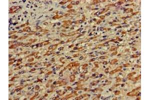 Immunohistochemistry of paraffin-embedded human liver cancer using ABIN7155043 at dilution of 1:100 (c-MET 抗体  (AA 83-209))