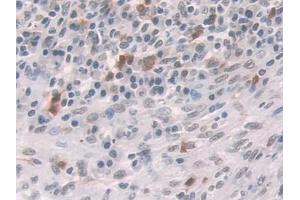 IHC-P analysis of Human Colorectal cancer Tissue, with DAB staining. (Glucocorticoid Receptor 抗体  (AA 532-730))