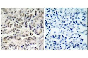 Immunohistochemical analysis of paraffin-embedded human lung carcinoma tissue using p27Kip1 (Ab-10) antibody (E021150). (CDKN1B 抗体)