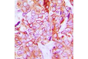 Immunohistochemical analysis of HER3 (pY1328) staining in human breast cancer formalin fixed paraffin embedded tissue section. (ERBB3 抗体  (C-Term, pTyr1328))