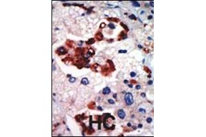 Formalin-fixed and paraffin-embedded human cancer tissue reacted with the primary antibody, which was peroxidase-conjugated to the secondary antibody, followed by AEC staining. (PKC iota 抗体  (N-Term))