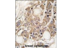 Formalin-fixed and paraffin-embedded human breast carcinoma tissue reacted with Vimentin Antibody (S82) (ABIN389211 and ABIN2839366) , which was peroxidase-conjugated to the secondary antibody, followed by DAB staining. (Vimentin 抗体  (AA 63-90))