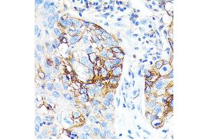 Immunohistochemistry of paraffin-embedded Human lung cancer using ICAM-1/CD54 antibody (ABIN7267941) at dilution of 1:100 (40x lens).