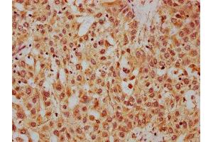IHC image of ABIN7155258 diluted at 1:400 and staining in paraffin-embedded human liver cancer performed on a Leica BondTM system. (HRG 抗体  (AA 412-511))